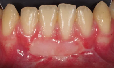 caso exito clinica dental murcia